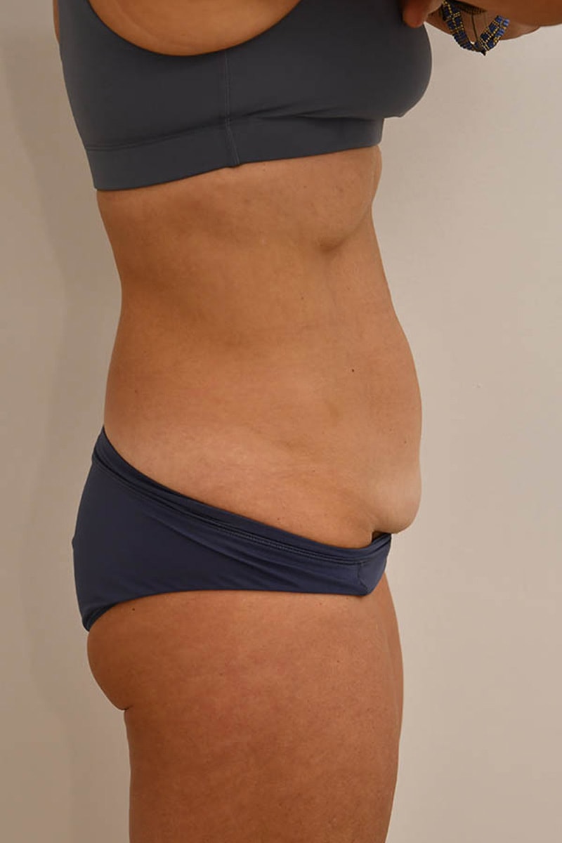 Tummy Tuck Before & After Image