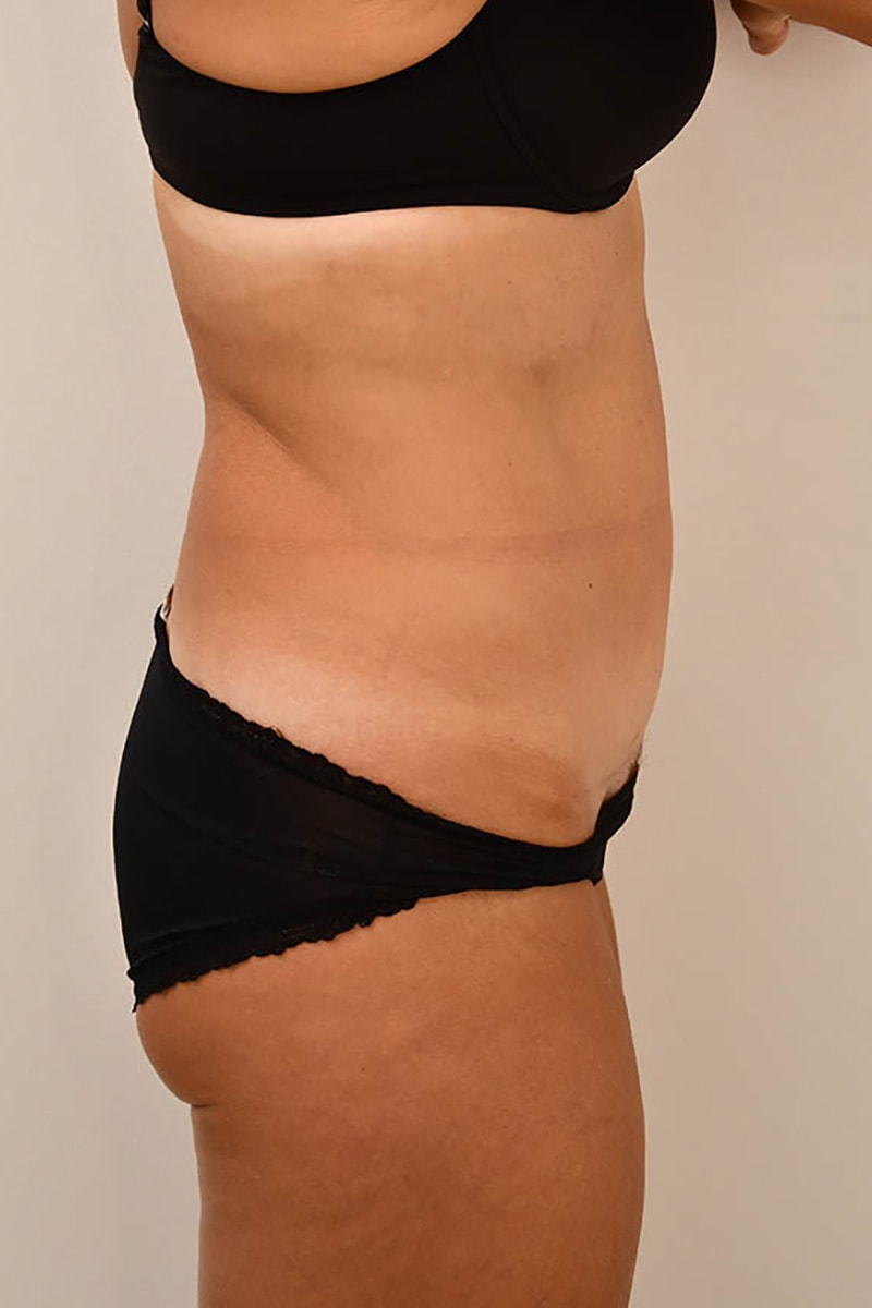 Tummy Tuck Before & After Image