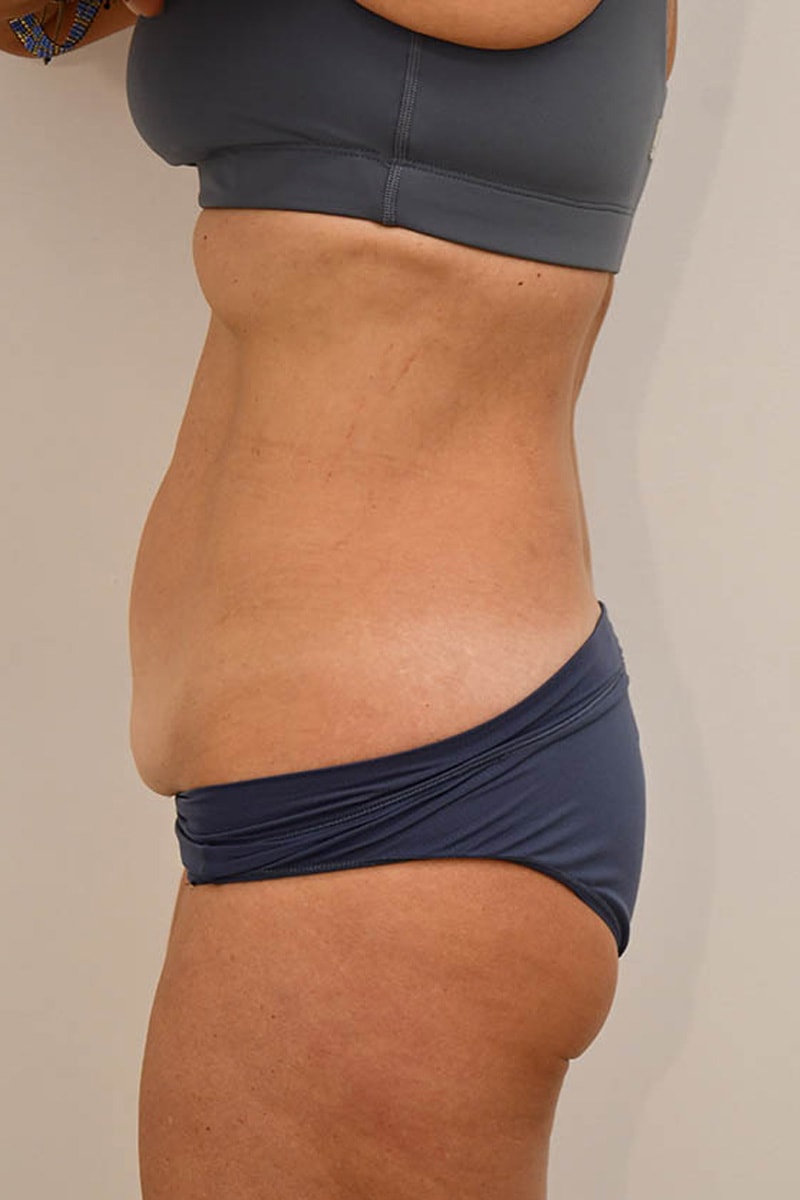 Tummy Tuck Before & After Image