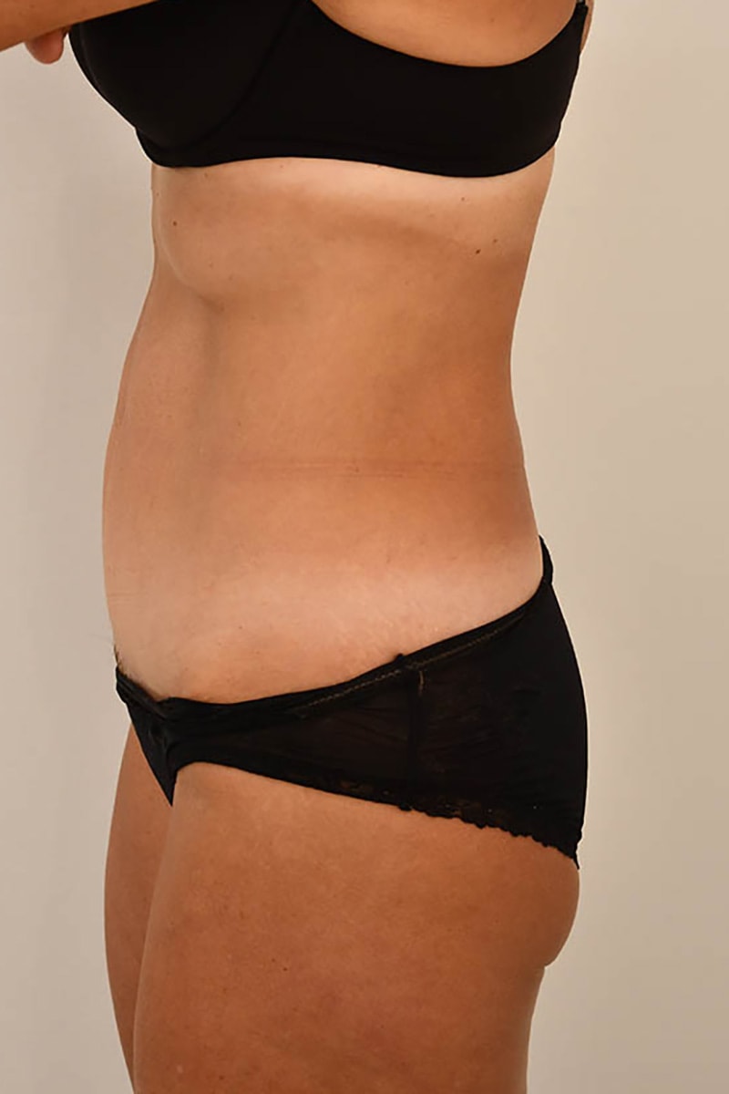 Tummy Tuck Before & After Image