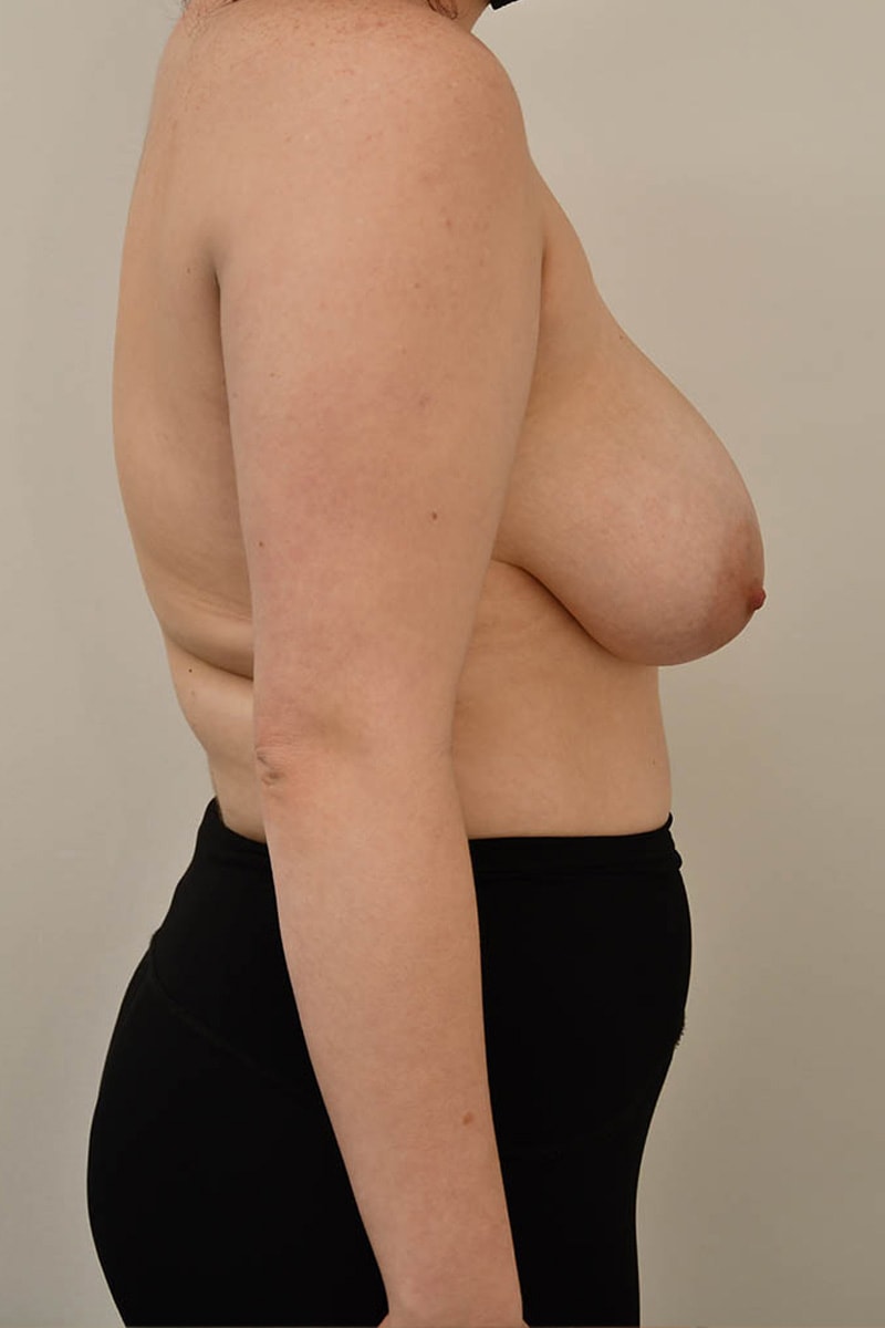 Breast Reduction Before & After Image