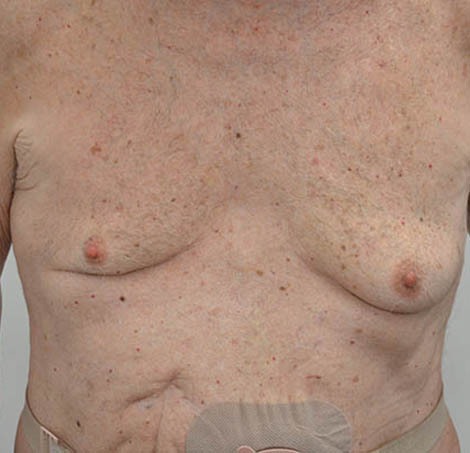 Gynecomastia Before & After Image