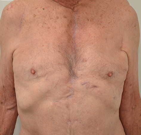 Gynecomastia Before & After Image