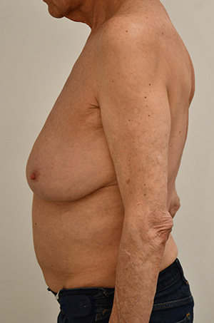 Gynecomastia Before & After Image