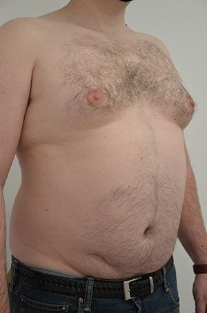 Gynecomastia Before & After Image