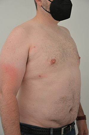 Gynecomastia Before & After Image