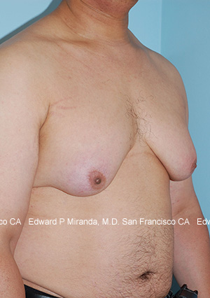 Gynecomastia Before & After Image