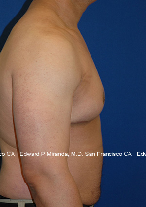 Gynecomastia Before & After Image