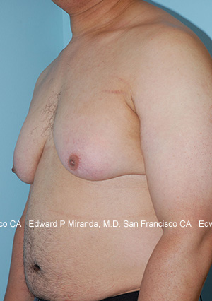 Gynecomastia Before & After Image