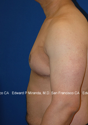 Gynecomastia Before & After Image