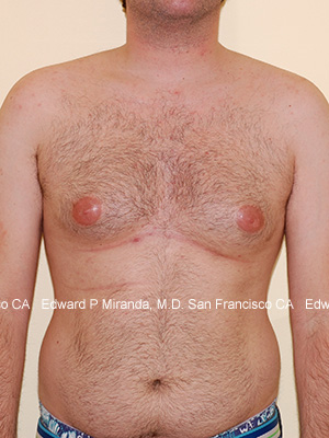 Gynecomastia Before & After Image