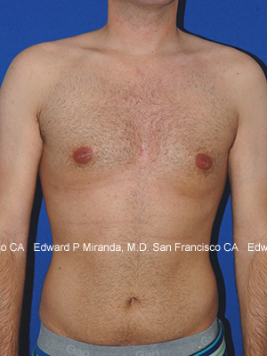 Gynecomastia Before & After Image