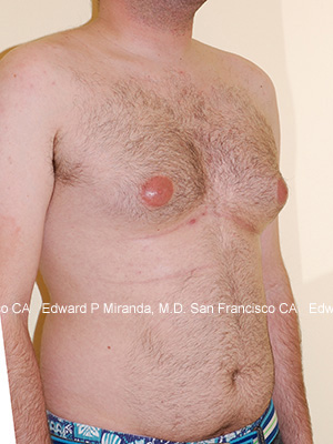 Gynecomastia Before & After Image