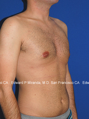 Gynecomastia Before & After Image