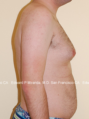 Gynecomastia Before & After Image