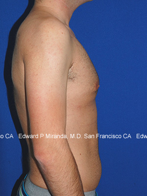 Gynecomastia Before & After Image