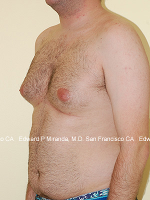 Gynecomastia Before & After Image