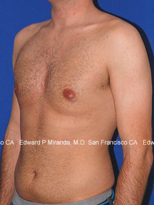 Gynecomastia Before & After Image