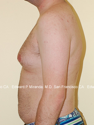 Gynecomastia Before & After Image