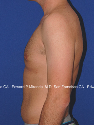 Gynecomastia Before & After Image