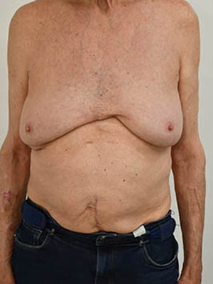 Gynecomastia Before & After Image