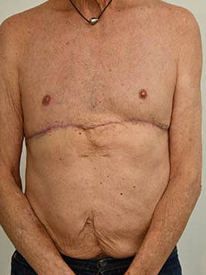 Gynecomastia Before & After Image