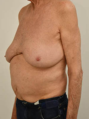 Gynecomastia Before & After Image