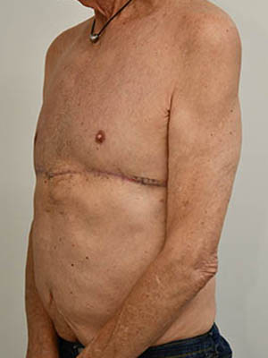 Gynecomastia Before & After Image