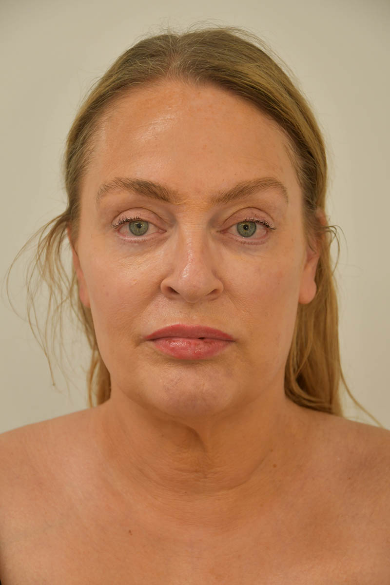 Facelift Before & After Image