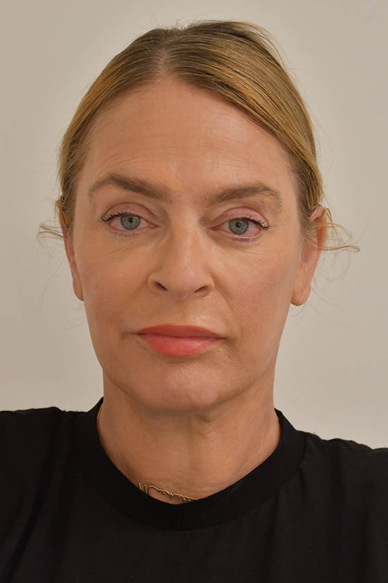 Facelift Before & After Image