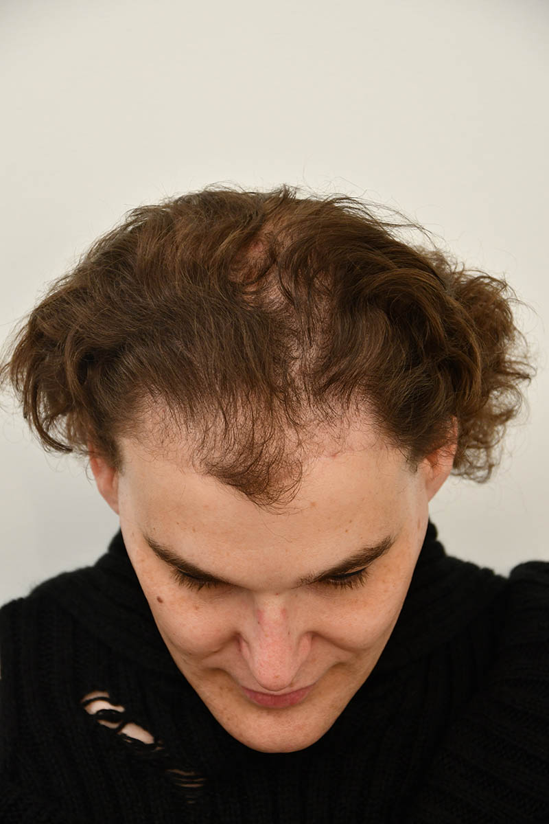 Hair Transplant Before & After Image